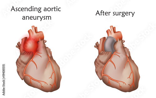 Ascending aortic aneurysm before and after repair. Tube graft and damaged heart muscle. Anatomy illustration. Colorful image, white background.