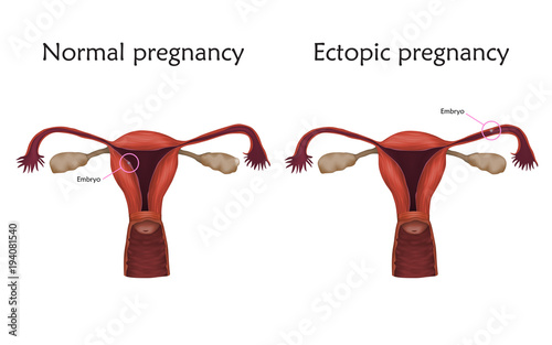 Ectopic and normal pregnancy. The fertilized egg, uterus, womb. Anatomy illustration. White background.