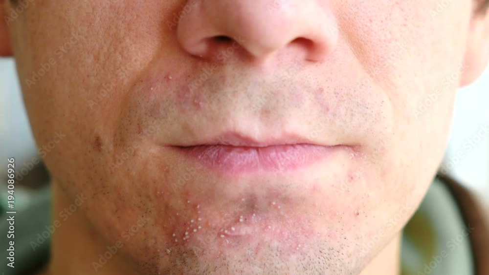 Skin irritation after shaving. Man rubs his hand pimples on his chin closeup. Skin irritation after shaving. Man rubs his hand pimples on his chin closeup.