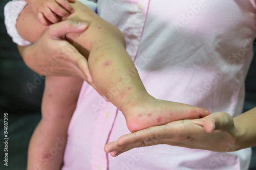 Hand foot and mouth disease.