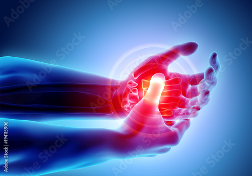 Palm painful - skeleton x-ray, Medical concept. photo