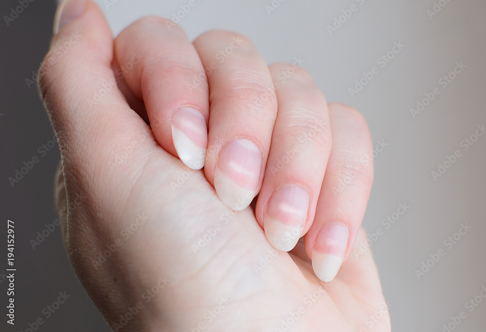 Leukonychia. Woman nails with white spots. Leuconychia partialis punctata  or milk nails. Stock Photo | Adobe Stock