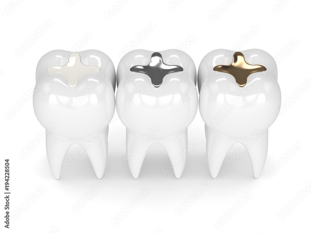 render of teeth Photo & Art Print 3d render of teeth with different types of dental  filling, Aleksandra Gigowska