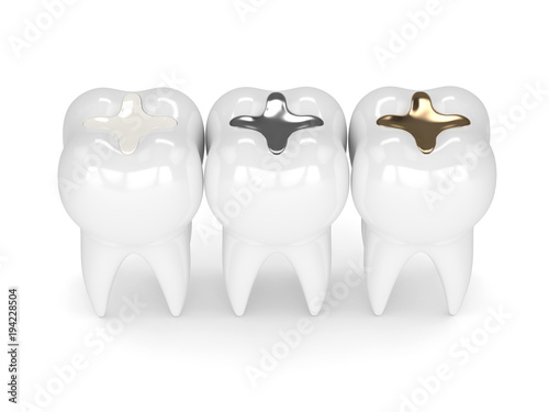 3d render of teeth with different types of dental filling photo