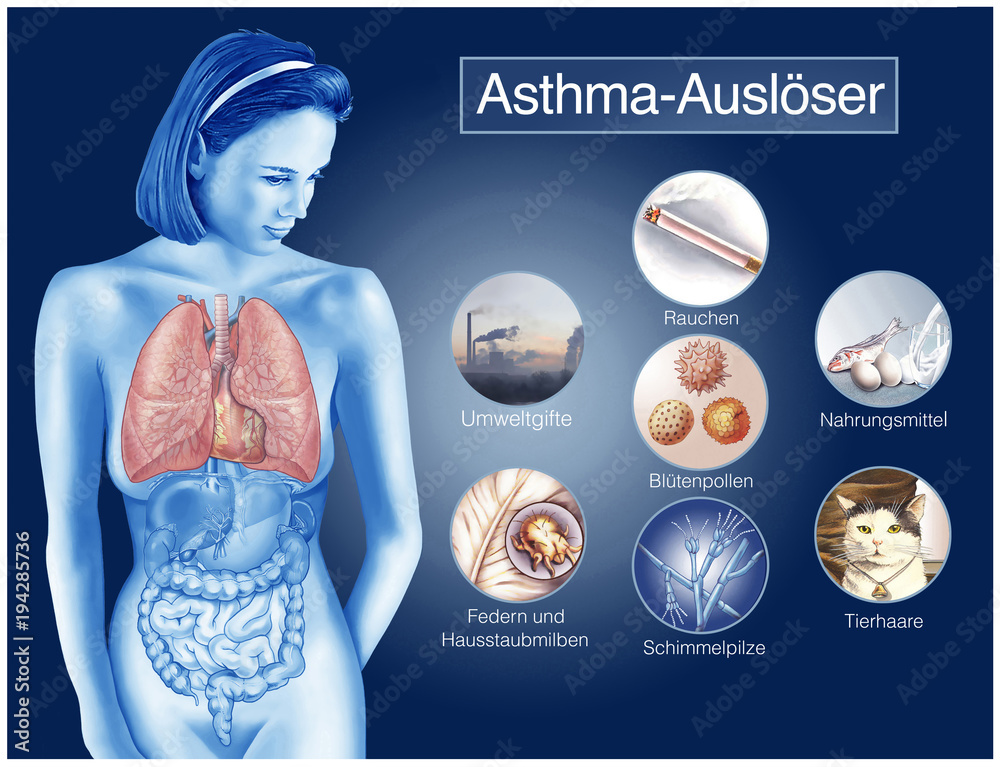 Asthma-Auslöser.Allergien.Immunsystem. Stock-Illustration | Adobe Stock