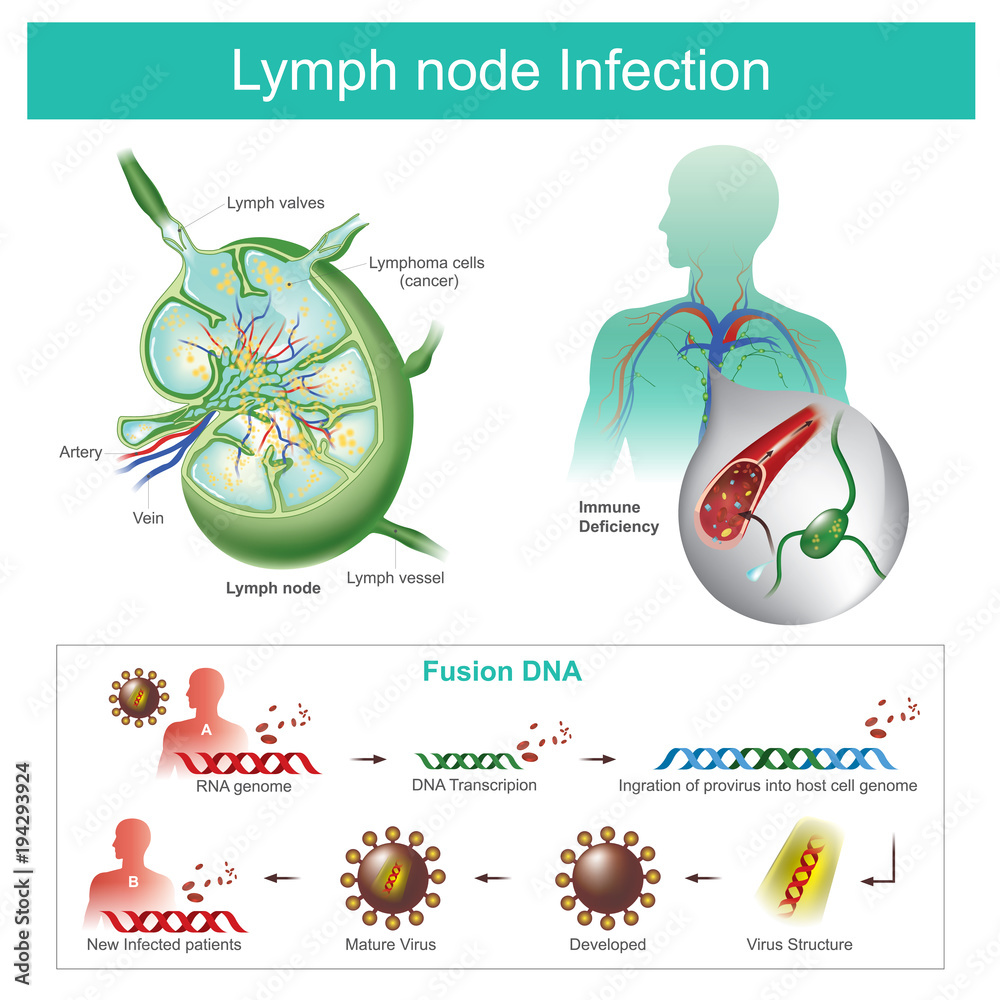 The Lymph nodes are infected Failure of the immune system, the body ...