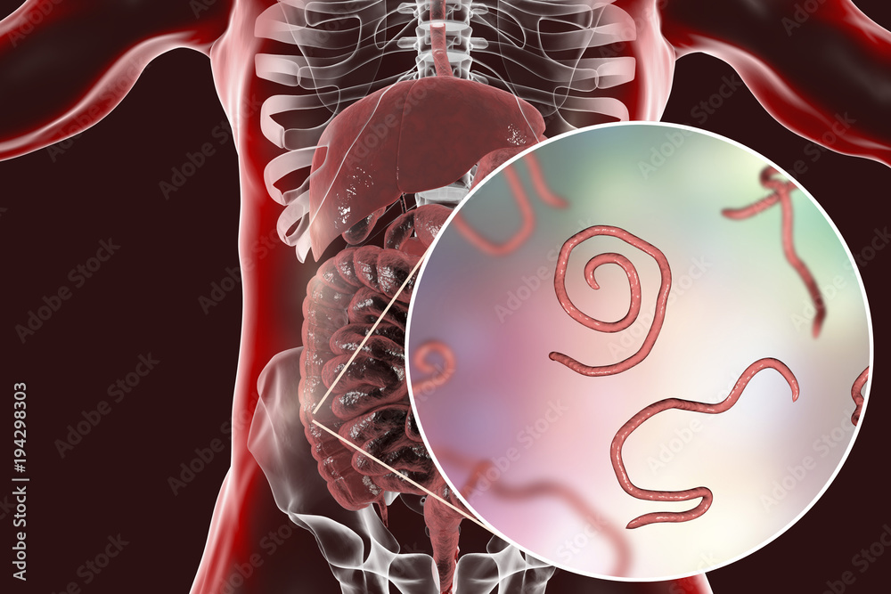 Helminths nematodes Enterobius in the gut. Threadworm which causes ...