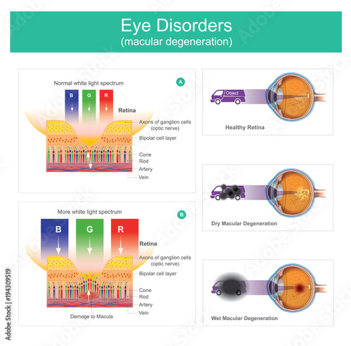 Macular degeneration is a medical condition which may result in blurred or no vision, Early on there are often no symptoms.