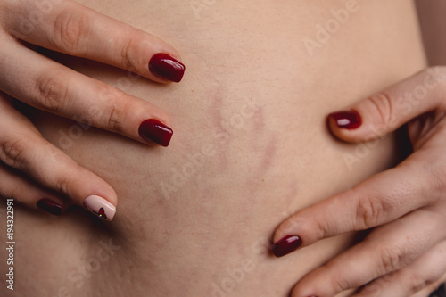 female hands touch the stretch marks on the belly