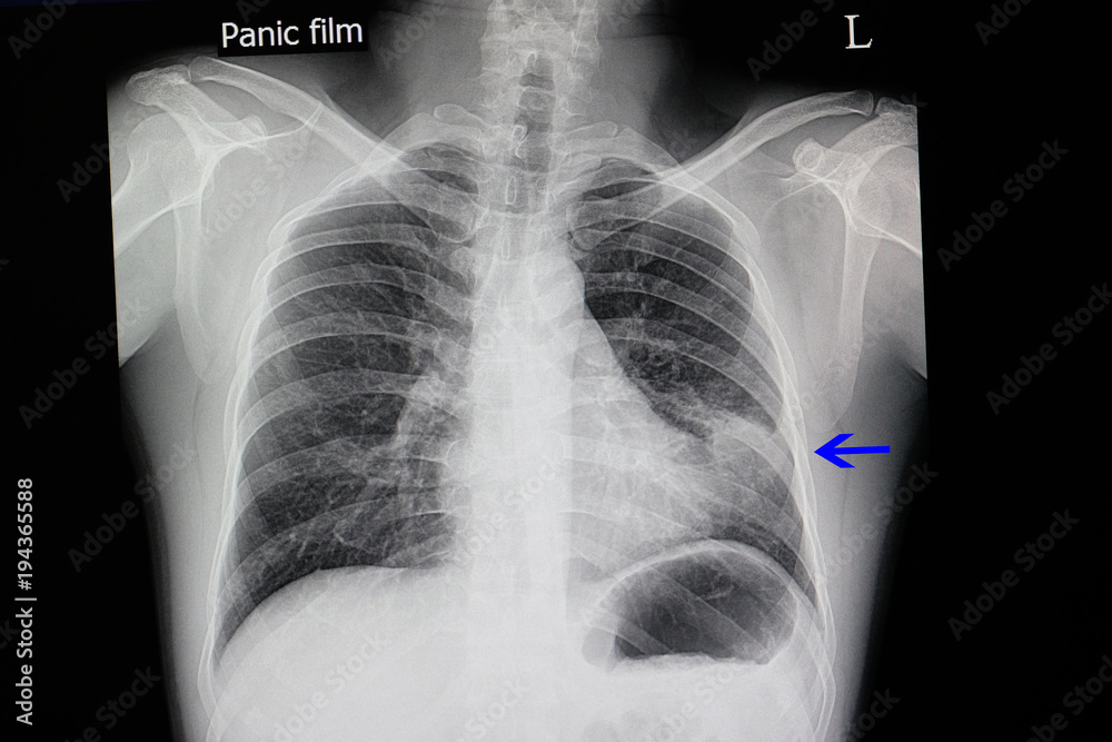 chest x-ray of a patient with pneumonia chest x-ray of a patient with pneumonia