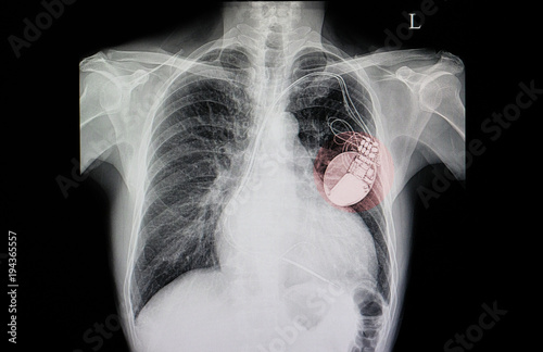 Chest x-ray film of a patient with cardiac pacemaker.