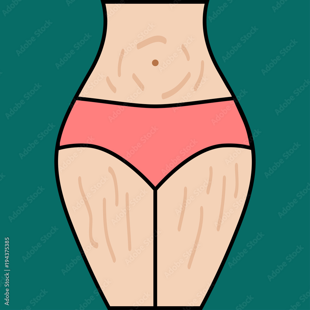 Striae on thighs of woman Striae on thighs of woman
