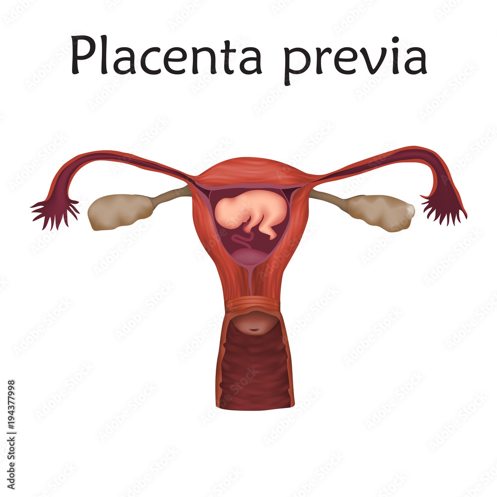 Placenta previa. Embryo, fetus in uterus, placenta, umbilical cord