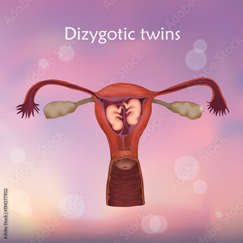 Multiple pregnancy. Dizygotic twins, embryo, fetus in uterus, placenta, umbilical cord. Vector medical illustration. Colored image, white background.