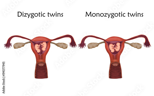 Multiple pregnancy. Dizygotic and monozygotic twins, embryo, fetus in uterus, placenta, umbilical cord. Vector medical illustration. Colored image, white background.