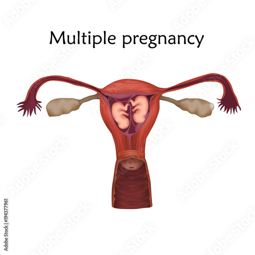 Multiple pregnancy, twins, embryo, fetus in uterus, placenta, umbilical cord. Vector medical illustration. Colored image, white background.
