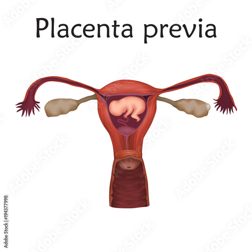 Placenta previa. Embryo, fetus in uterus, placenta, umbilical cord. Vector medical illustration. Colored image, white background.