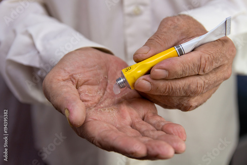 Ointment on the hands of an elderly person. Applying the ointment and emollient cream in the treatment and hydration of the skin . Problem skin in old age