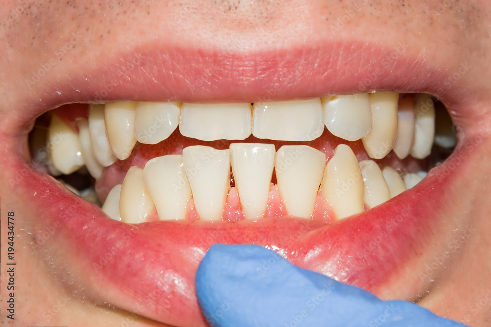 Fototapeta premium próchnica zepsuty zbliżenie zęba sfotografowany