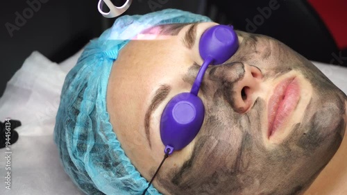 Beautician laser removes old skin with carbon fiber layer. Processing of forehead area. Carbon peeling.