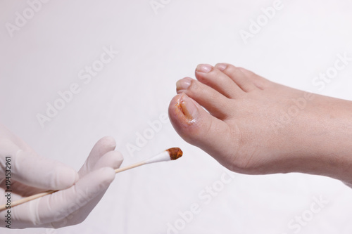 Ingrow toe nail wound care by nurse after doctor perform surgery by cut the part of nail off