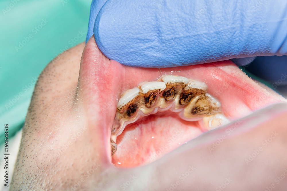 close-up of a human rotten carious tooth at the treatment stage in a dental clinic close-up of a human rotten carious tooth at the treatment stage in a dental clinic