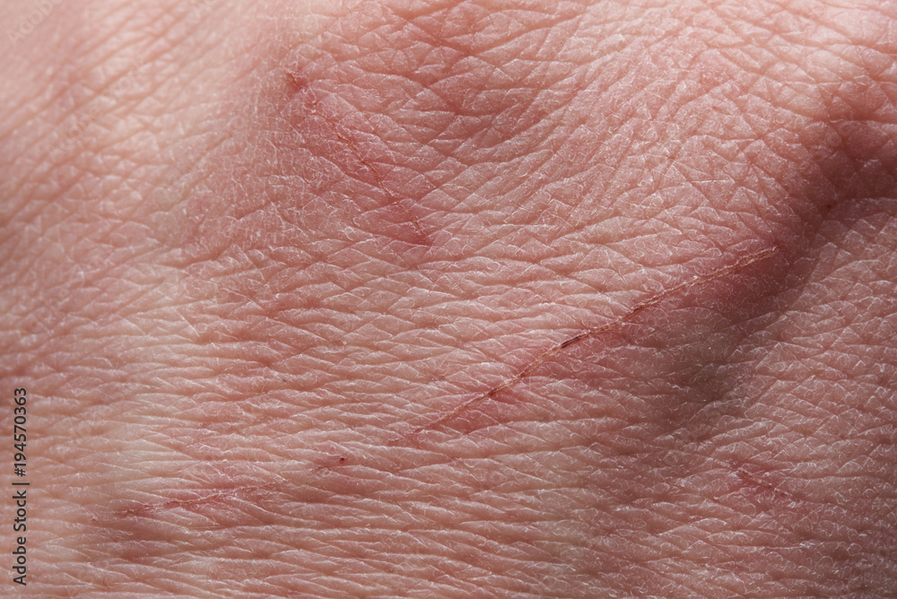 Damaged with scratch human skin Damaged with scratch human skin