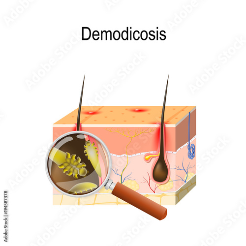 Demodicosis. Cross section of the skin with demodex mites.