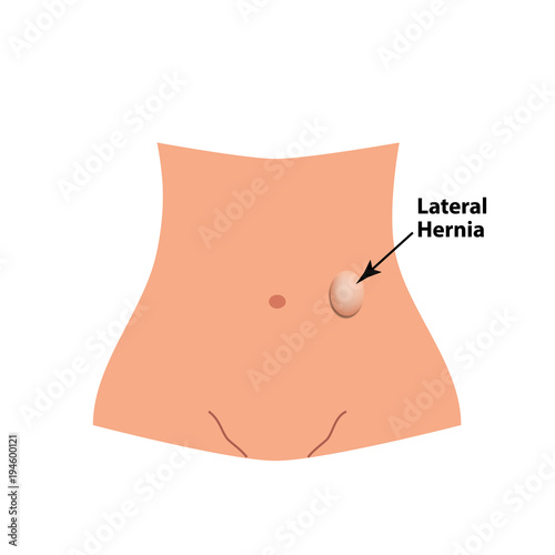 Lateral Herniation. intestinal hernia. Infographics. Vector illustration on isolated background.