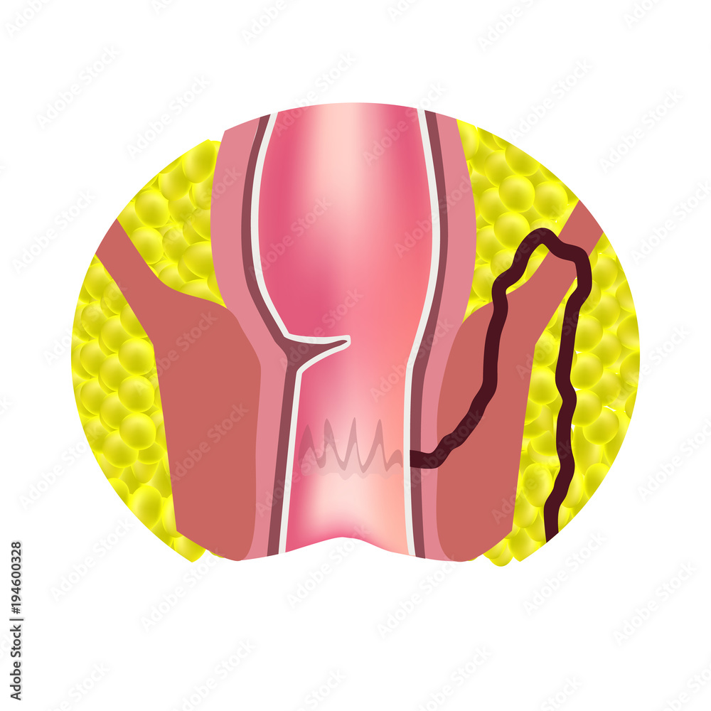 Fistula