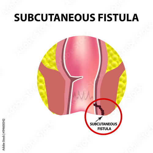 Types of fistulas of the rectum. Paraproctitis. Anus. Abscess of the rectum. Infographics. Vector illustration on isolated background