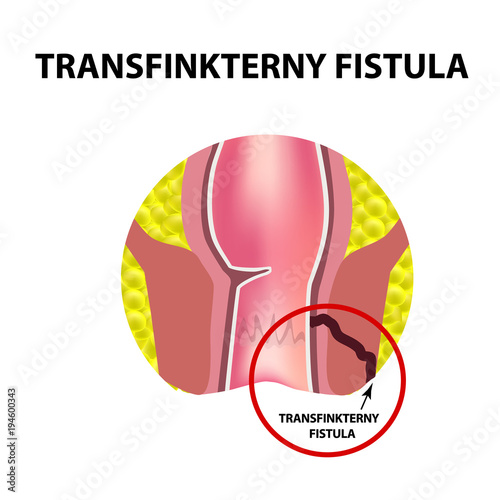 Types of fistulas of the rectum. Paraproctitis. Anus. Abscess of the rectum. Infographics. Vector illustration on isolated background