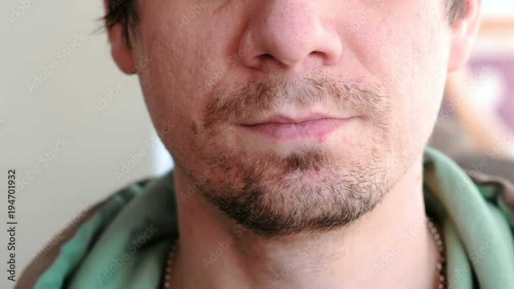 Herpes. Lip treatment. Close-up of the man's lips with herpes. Front view. Herpes. Lip treatment. Close-up of the man's lips with herpes. Front view.