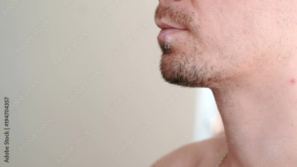 Herpes. Lip treatment. Close-up of the man's lips with herpes and cream on lips. Front view. Herpes. Lip treatment. Close-up of the man's lips with herpes and cream on lips. Front view.