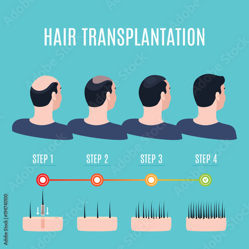 Hair transplantation surgery steps infographics. Patient before and after the procedure. Male hair loss treatment with FUT, FUE method. Alopecia medical design for clinics and diagnostic centers.
