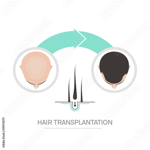 Hair transplantation surgery steps infographics. Patient before and after the procedure. Male hair loss treatment with FUT, FUE method. Alopecia medical design for clinics and diagnostic centers.