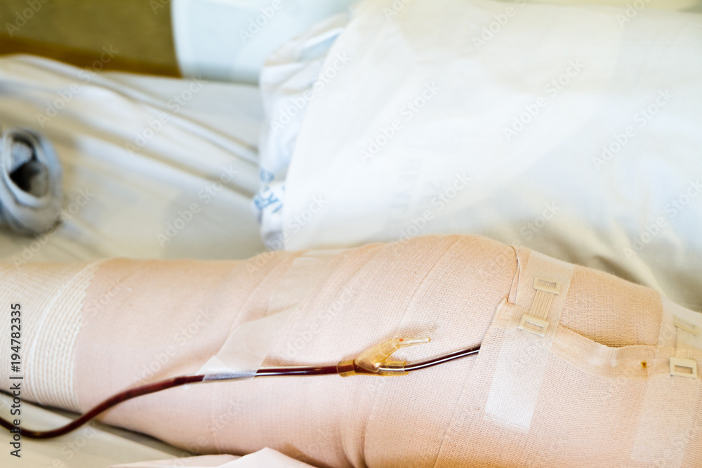 Blood Drain in Knee Replacement Patient. Close up of leg including knee