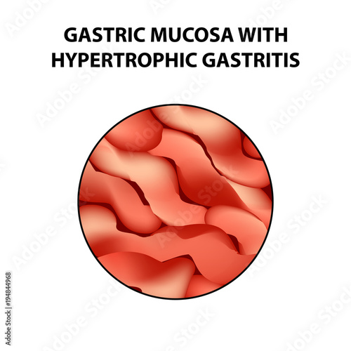 Gastric mucosa with hypertrophic gastritis. Infographics. Vector illustration on isolated background