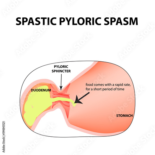 spasms of the pylorus. Pylorospasm. Spastic Pyloric sphincter of the stomach. Infographics. Vector image on isolated background