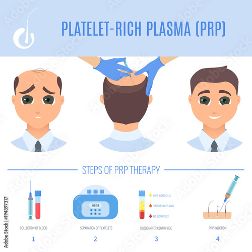 Platelet rich plasma injection procedure. PRP therapy process for men. Male hair loss treatment infographics. Hair regrowth stimulation method. For cosmetology beauty clinic. Vector illustration.