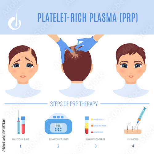 Platelet rich plasma injection procedure. PRP therapy process for women. Female hair loss treatment infographics. Hair regrowth stimulation method. For cosmetology beauty clinic. Vector illustration.