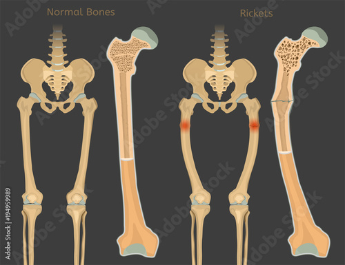 Vector Rickets Scheme