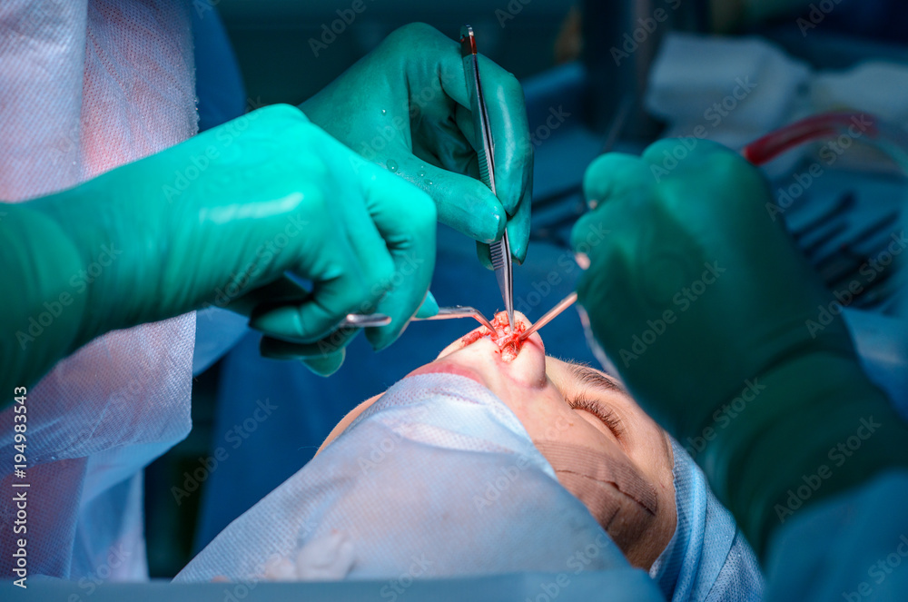 Plastic surgery of the nose in operating room, rhinoplasty Plastic surgery of the nose in operating room, rhinoplasty