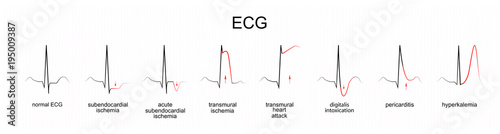 interpretation of ECG photo