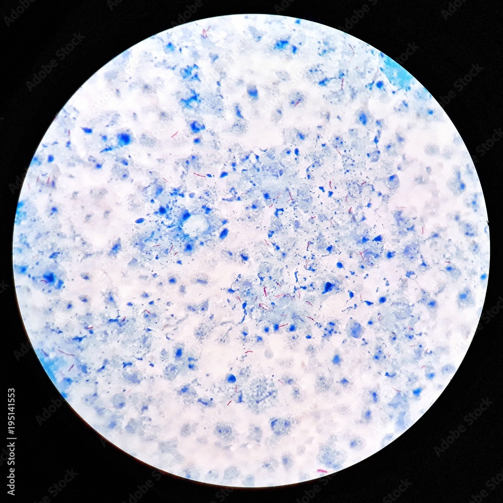 Foto de Smear of positive AcidFast bacilli (AFB) bacteria stained