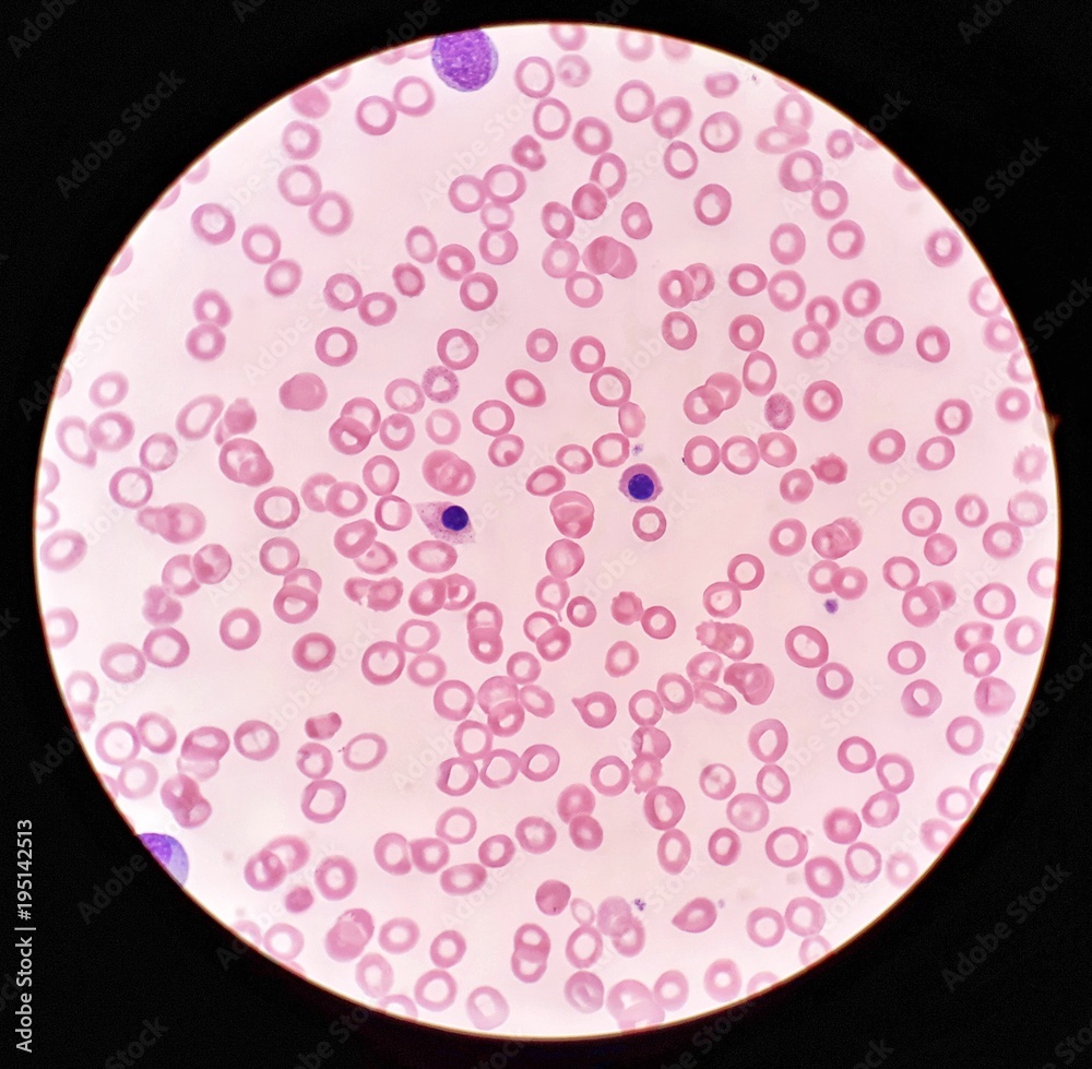 Human blood smear under 100X light microscope with nucleated red blood cells and hypochromic blood cells (Selective focus). Stock Photo Adobe