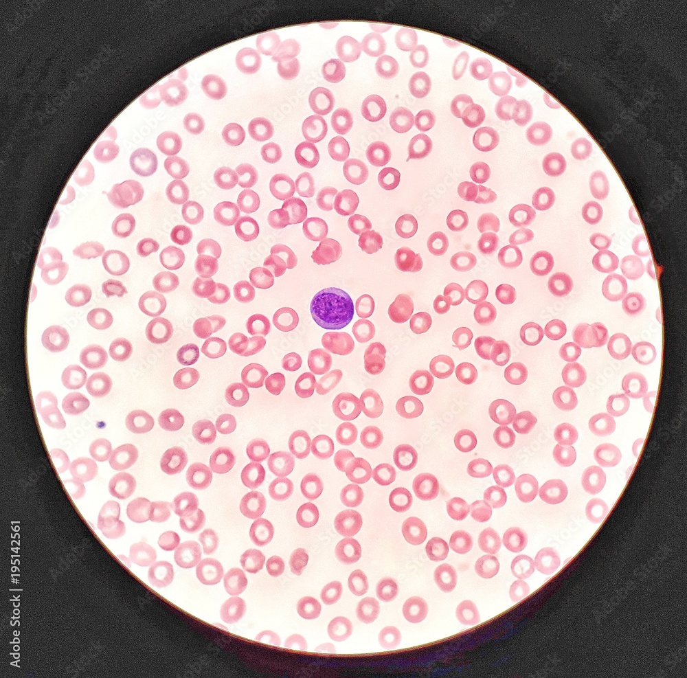 Human blood smear under 100X light microscope with blast cell and ...
