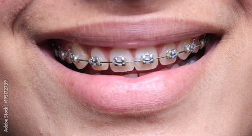 Dental braces