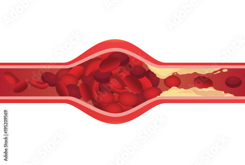 Arteries swelling because blood clot by fat cloged made blood flow slowly. Illustration about danger of Cholesterol.
