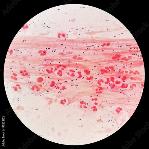 Smear of Gram's stained from sputum specimen with gram positive cocci bacteria, mucous and numerous white blood cells, under 100X light microscope . photo
